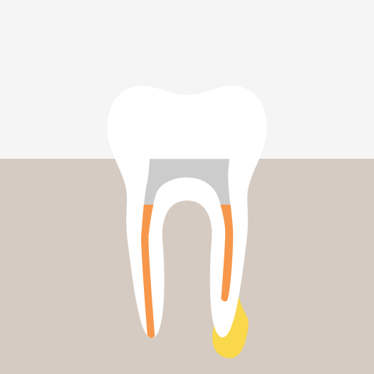 Root Canal Retreatment