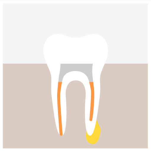 Root Canal Retreatment