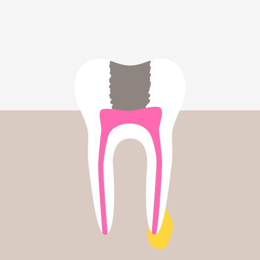 Root Canal Treatment