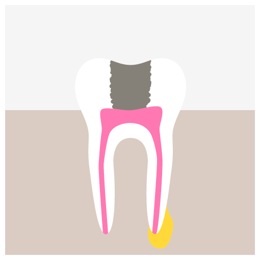 Root Canal Treatment