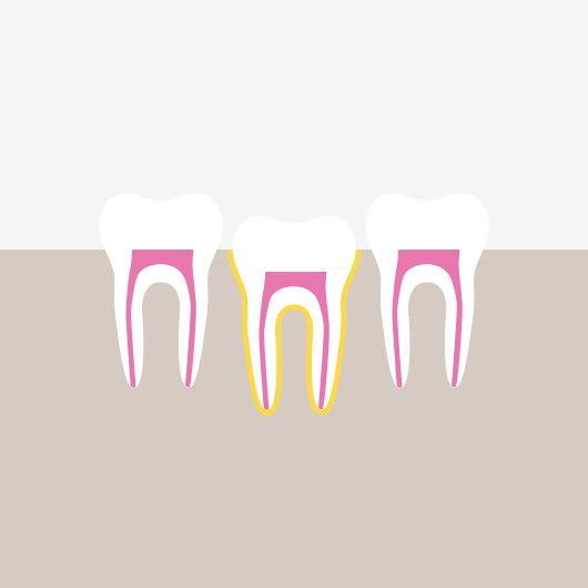 Traumatic Dental Injuries