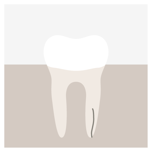 Vertical Root Fracture