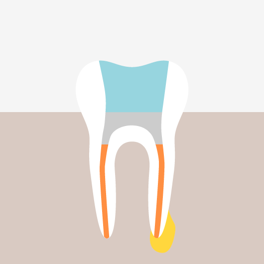 Root Canal Treatment - The Filling